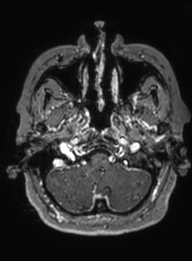 Cavernous hemangioma of the cerebellar falx (Radiopaedia 73025-83724 Axial T1 C+ 296).jpg