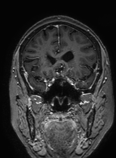 Cavernous hemangioma of the cerebellar falx (Radiopaedia 73025-83724 Coronal T1 C+ 125).jpg