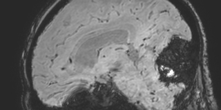 Cavernous hemangioma of the cerebellar falx (Radiopaedia 73025-83724 Sagittal BOLD 91).jpg