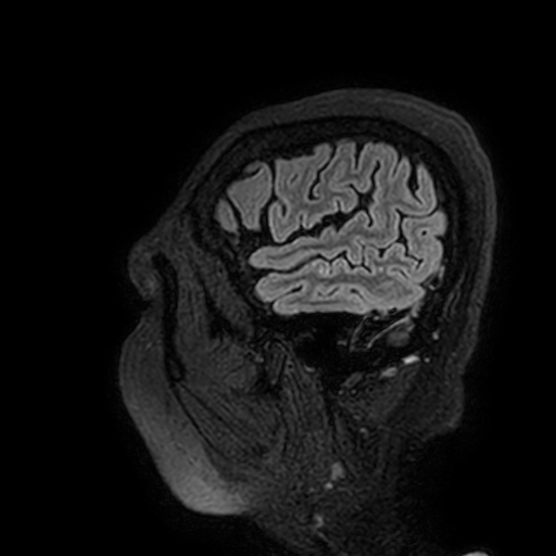 Cavernous hemangioma of the cerebellar falx (Radiopaedia 73025-83724 Sagittal FLAIR 196).jpg