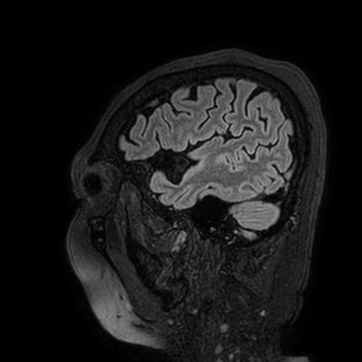 Cavernous hemangioma of the cerebellar falx (Radiopaedia 73025-83724 Sagittal FLAIR 28).jpg