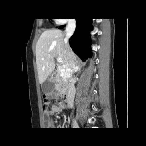 Cavernous hepatic hemangioma (Radiopaedia 75441-86667 D 79).jpg
