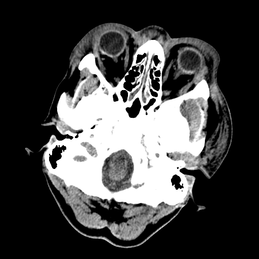 File:Cavernous sinus thrombosis (Radiopaedia 10619-11078 Axial non-contrast 5).jpg