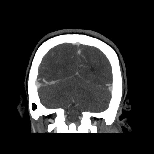 File:Cavernous sinus thrombosis (Radiopaedia 10619-11078 D 26).jpg