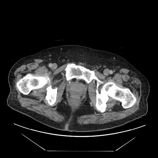Cecal adenocarcinoma (Radiopaedia 64871-73817 A 96).jpg
