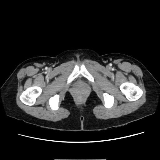 Cecal adenocarcinoma (Radiopaedia 75909-87331 A 90).jpg