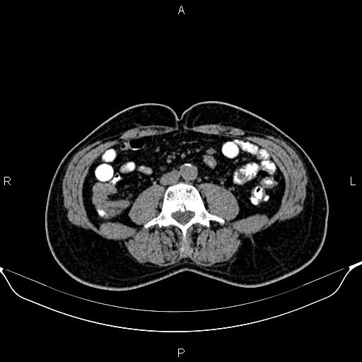 Cecal adenocarcinoma (Radiopaedia 85324-100916 Axial non-contrast 55).jpg