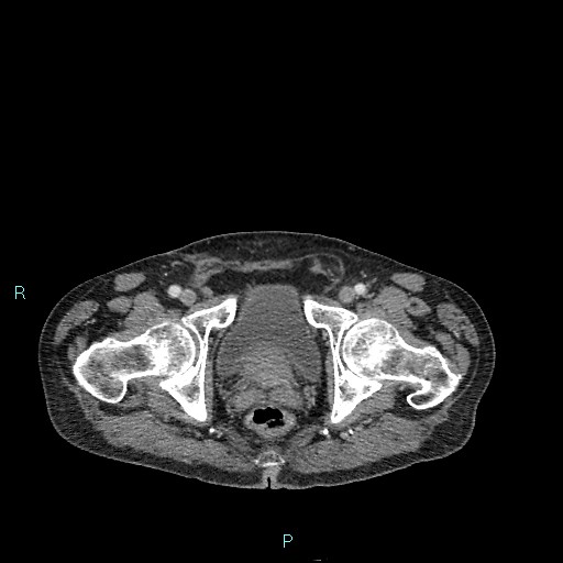 Cecal bascule (Radiopaedia 85770-101586 C 103).jpg
