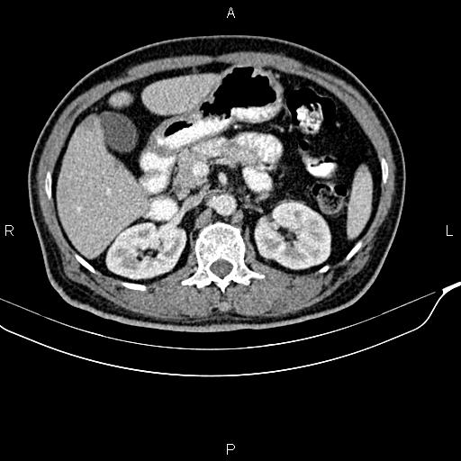 File:Cecal cancer with appendiceal mucocele (Radiopaedia 91080-108651 B 39).jpg