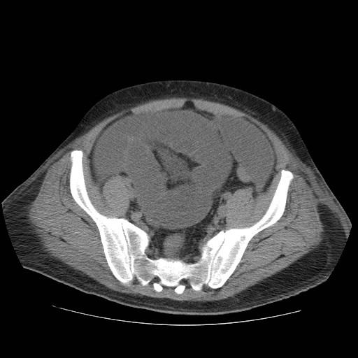 Cecal volvulus (Radiopaedia 28294-28534 Axial non-contrast 75).jpg