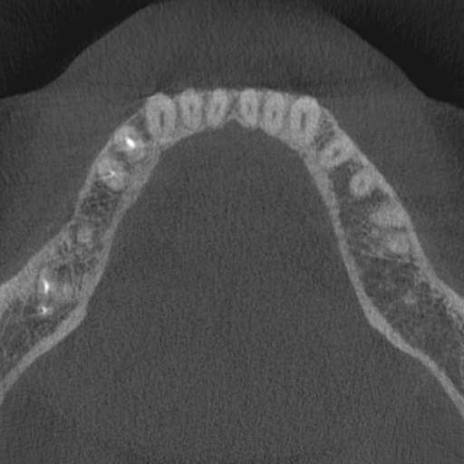 Cemento-osseous dysplasia (Radiopaedia 48251-53126 Axial non-contrast 38).jpg