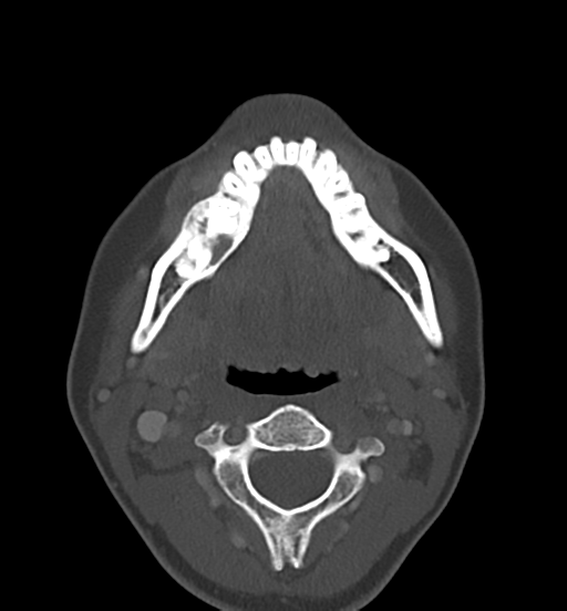 Cemento-ossifying fibroma (Radiopaedia 46243-50643 Axial bone window 42).png