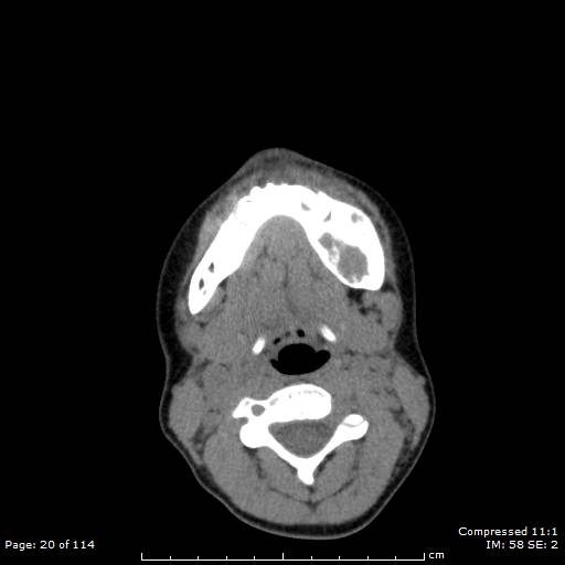 File:Central giant cell granuloma (Radiopaedia 45612-49754 Axial 96).jpg