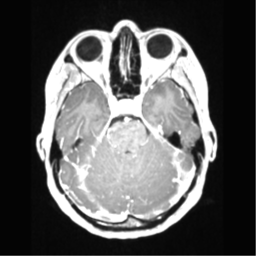 File:Central neurocytoma (Radiopaedia 37664-39557 Axial T1 C+ 27).png
