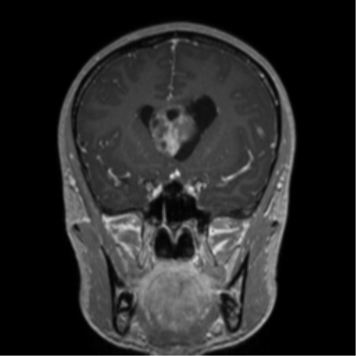 Central neurocytoma (Radiopaedia 37664-39557 Coronal T1 C+ 56).png