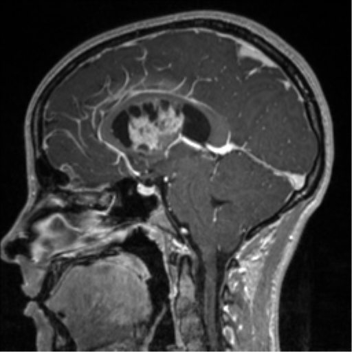Central neurocytoma (Radiopaedia 37664-39557 Sagittal T1 C+ 51).png
