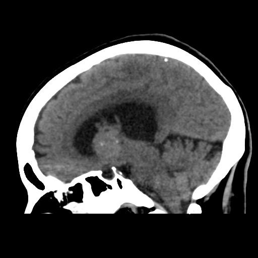 File:Central neurocytoma (Radiopaedia 65317-74346 C 29).png