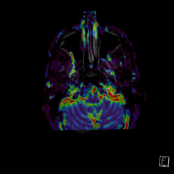 Central neurocytoma (Radiopaedia 84497-99872 Axial Perfusion 271).jpg