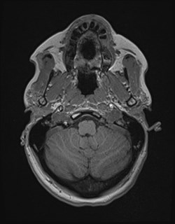 Central neurocytoma (Radiopaedia 84497-99872 Axial T1 40).jpg