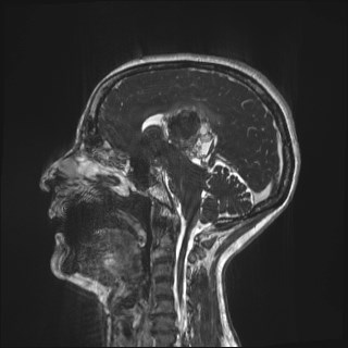 Central neurocytoma (Radiopaedia 84497-99872 Sagittal CISS 49).jpg