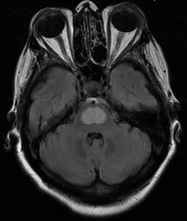 File:Central pontine myelinolysis (Radiopaedia 11286-11650 Axial 1).jpg