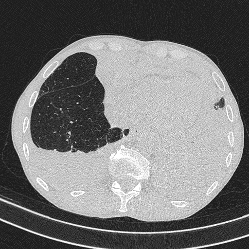 Central venous catheter tip extravasation (Radiopaedia 82828-97113 Axial lung window 68).jpg