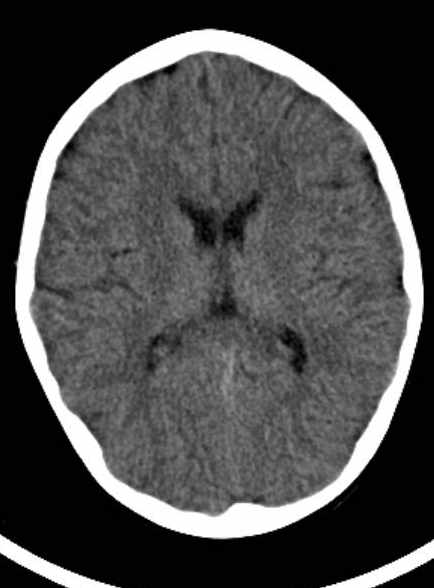 Cerebellar abscess (Radiopaedia 73727-84527 Axial non-contrast 42).jpg