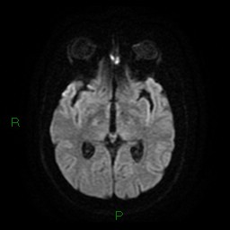 Cerebellar abscess (Radiopaedia 78135-90678 Axial DWI 15).jpg