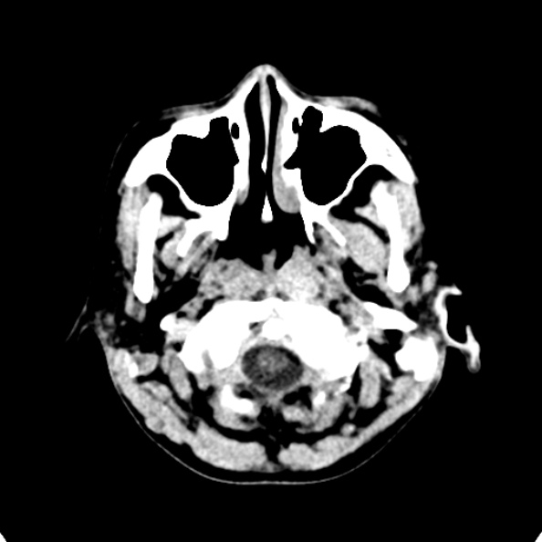 File:Cerebellar abscess secondary to mastoiditis (Radiopaedia 26284-26412 Axial non-contrast 8).jpg