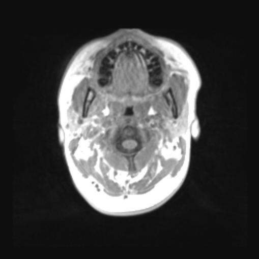 File:Cerebellar ependymoma complicated by post-operative subdural hematoma (Radiopaedia 83322-97736 Axial T1 2).png