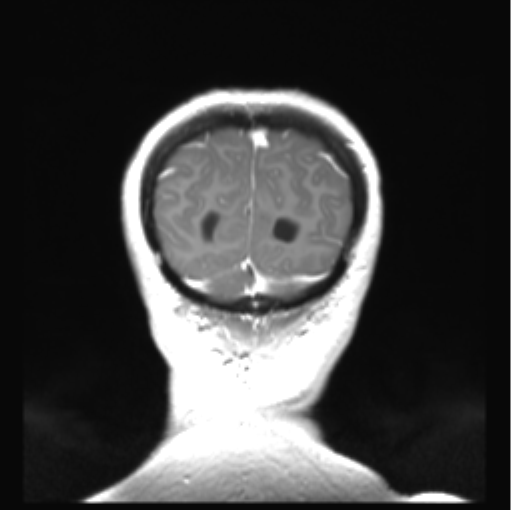 File:Cerebellar ependymoma complicated by post-operative subdural hematoma (Radiopaedia 83322-97736 Coronal T1 C+ 52).png