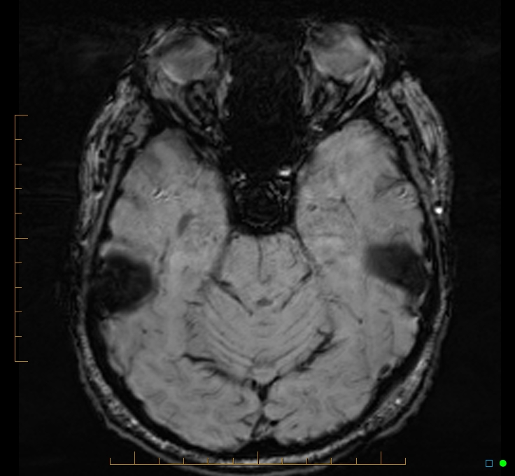 Cerebellar gangliocytoma (Radiopaedia 65377-74422 Axial SWI 19).jpg