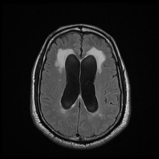File:Cerebellar hemangioblastoma (Radiopaedia 88055-104622 Axial FLAIR 17).jpg