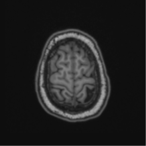 Cerebellar hemangioblastomas and pituitary adenoma (Radiopaedia 85490-101176 Axial T1 64).png