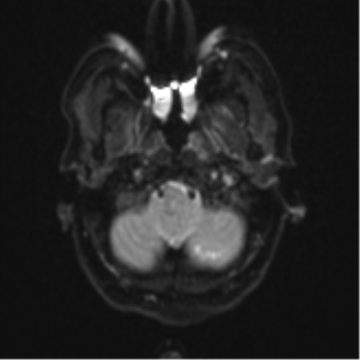 Cerebellar metastasis (Radiopaedia 51137-56765 Axial DWI 4).png
