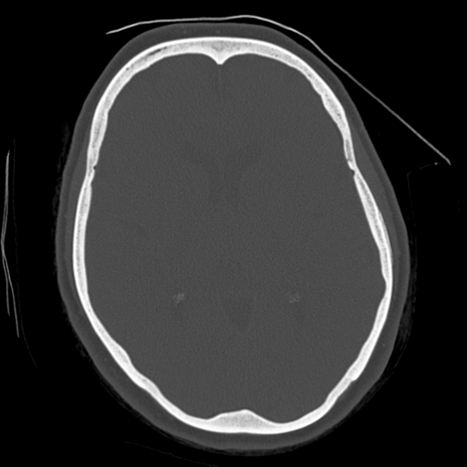 Cerebellar metastasis (cystic appearance) (Radiopaedia 41395-44258 Axial bone window 36).png