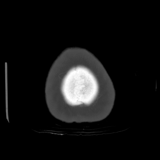 Cerebellar metastasis (cystic appearance) (Radiopaedia 41395-44258 Axial bone window 72).png