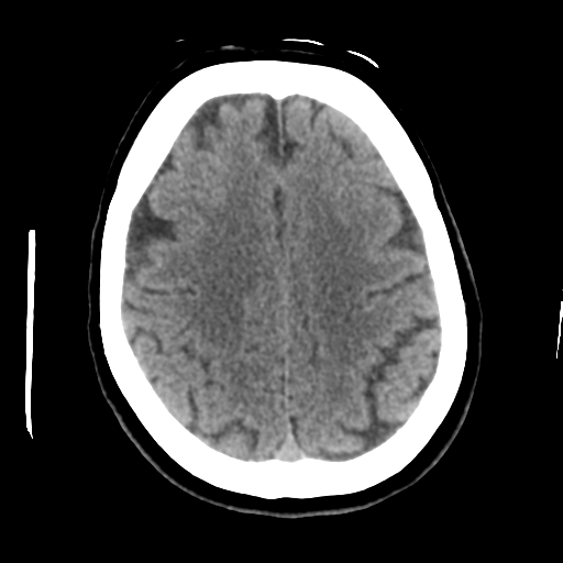 Cerebellar metastasis (cystic appearance) (Radiopaedia 41395-44258 Axial non-contrast 39).png