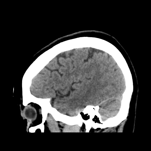 File:Cerebellar metastasis (cystic appearance) (Radiopaedia 41395-44258 E 43).png