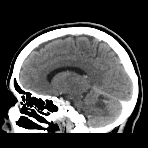 Cerebellar metastasis (cystic appearance) (Radiopaedia 41395-44258 F 31).png