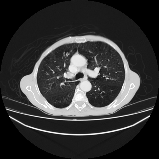File:Cerebellar metastasis - lung tumor (Radiopaedia 69317-79150 Axial lung window 13).jpg