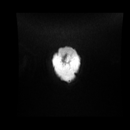 File:Cerebellar metastasis of pulmonary adenocarcinoma, cavernous venous malformation, and developmental venous anomaly (Radiopaedia 85827-101661 Coronal T1 C+ 5).jpg