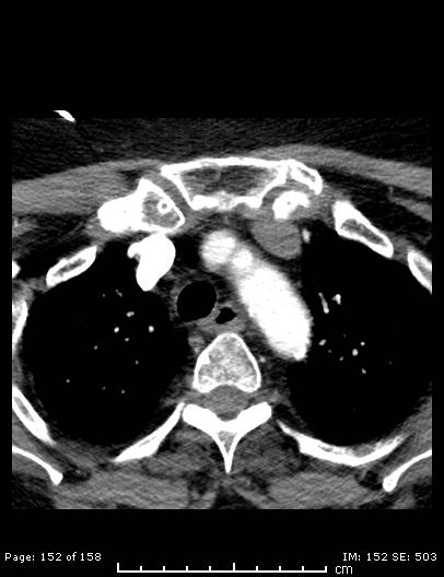 File:Cerebellar strokes due to intracranial giant cell arteritis (Radiopaedia 68799-78510 CT angiogram 152).jpg
