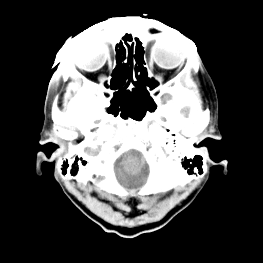 File:Cerebellopontine angle lipoma (Radiopaedia 18669-18568 Axial non-contrast 1).jpg