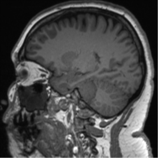 File:Cerebellopontine angle meningioma (Radiopaedia 48434-53348 Sagittal T1 36).png