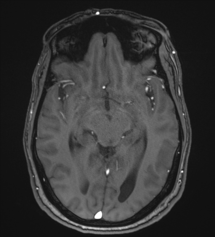 Cerebellopontine angle meningioma (Radiopaedia 72983-83680 Axial MRA 55).jpg