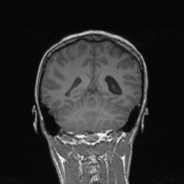 Cerebral abscess (Radiopaedia 24212-24478 Coronal T1 144).jpg