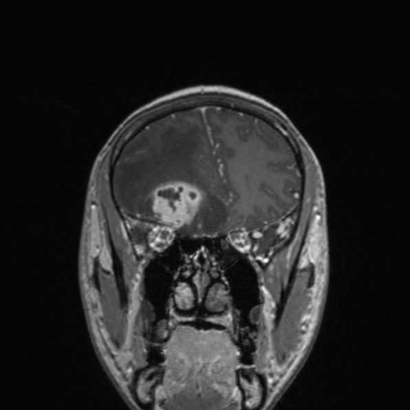 Cerebral abscess (Radiopaedia 24212-24478 Coronal T1 C+ 68).jpg