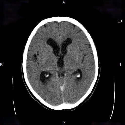 File:Cerebral abscess (Radiopaedia 7606-8432 Axial C+ delayed 9).jpg