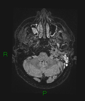 Cerebral abscess and subdural empyema (Radiopaedia 84436-99779 Axial FLAIR 67).jpg